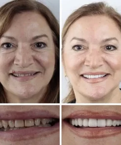 SEAGRIL™ --Advanced Customized Full Denture Set