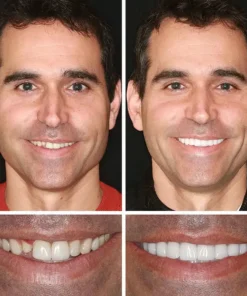 SEAGRIL™ --Advanced Customized Full Denture Set