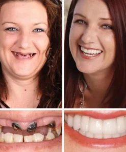 SEAGRIL™ --Advanced Customized Full Denture Set