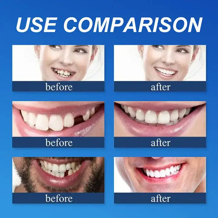 SEAGRIL™ --Advanced Customized Full Denture Set
