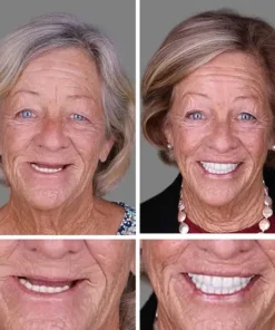 SEAGRIL™ --Advanced Customized Full Denture Set