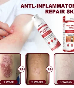 SEAGRIL® Beef Tallow Spray for Itchy, Flaky Psoriasis Skin