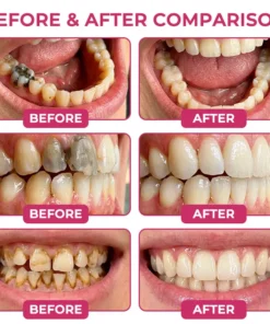 SEAGRIL® DenPerm Cavity-Repair Natural Enamel Filling Gel