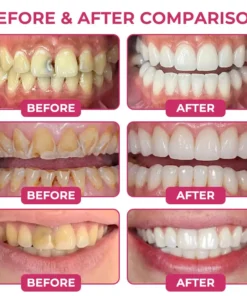 SEAGRIL® DenPerm Cavity-Repair Natural Enamel Filling Gel